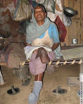 gfa_womanleprosy