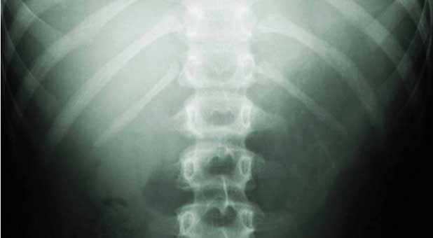 spine_xray